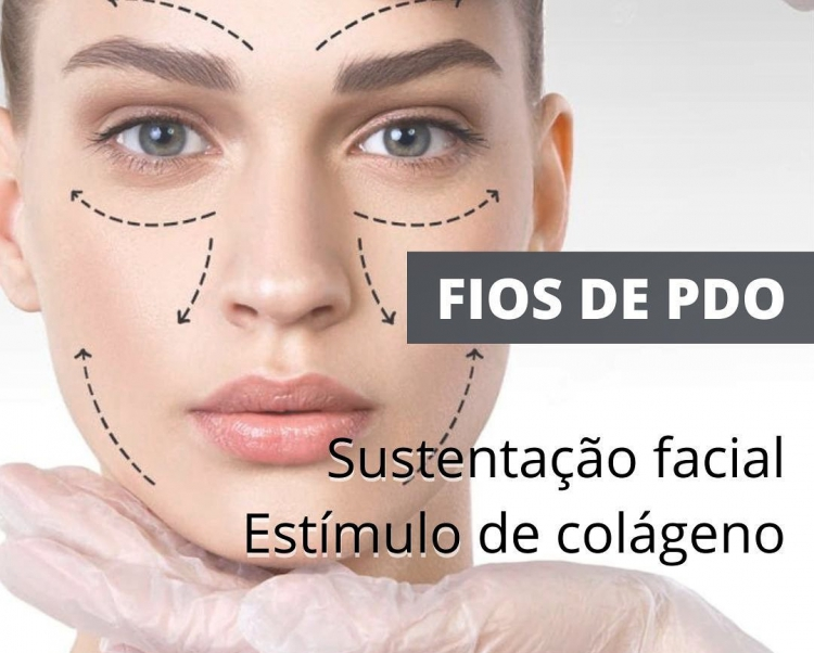 Fios de Sustentação (PDO) o Lifting NÃO cirurgico - saiba TUDO sobre!